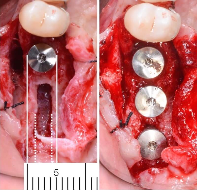 sinus lift crestal window