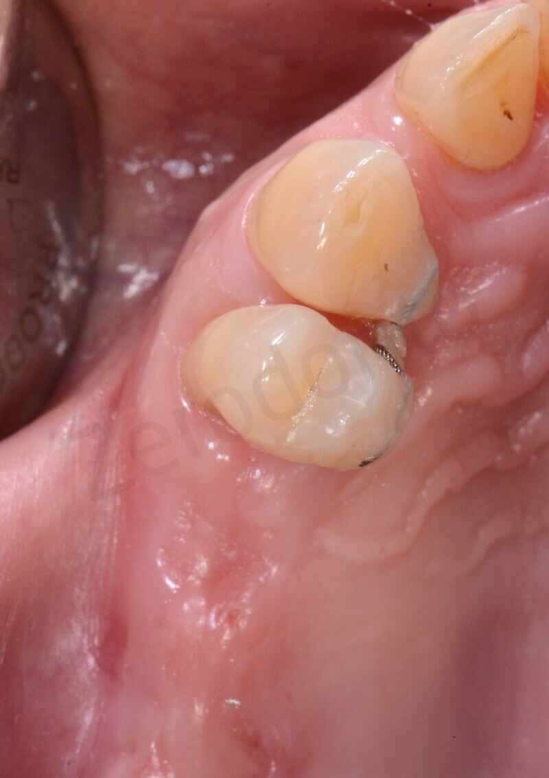 initial situation occlusal view