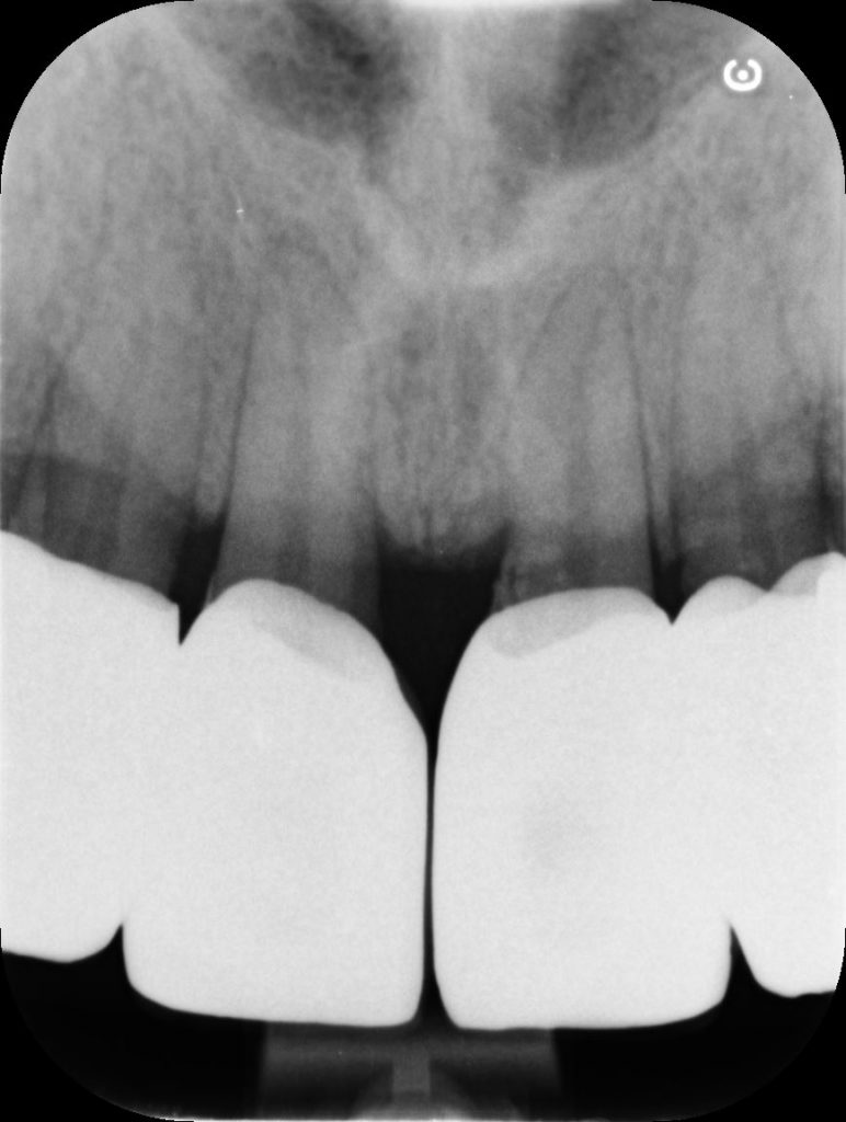 dental prosthesis rx