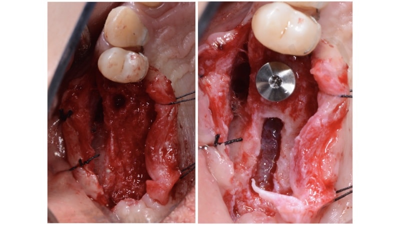 Sinus lift crestal approach