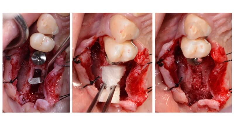 sinus lift crestal approach