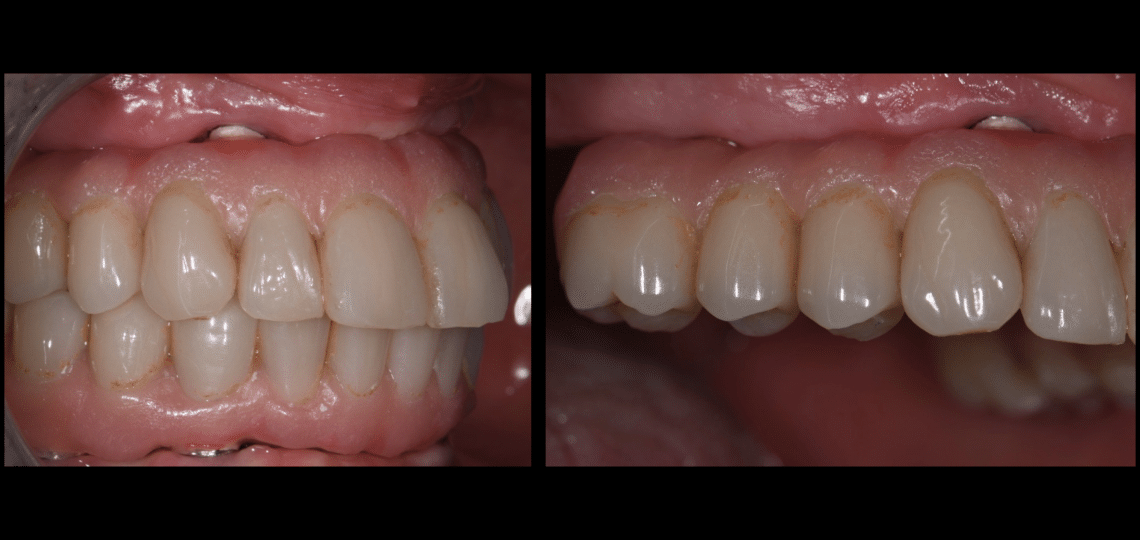 THE APPLICATION OF CAD - CAM TECHNIQUES FOR ALL-ON 4 - MyZerodonto