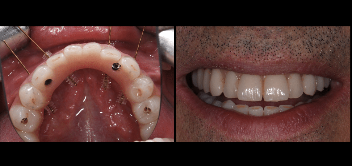 THE APPLICATION OF CAD - CAM TECHNIQUES FOR ALL-ON 4 - MyZerodonto