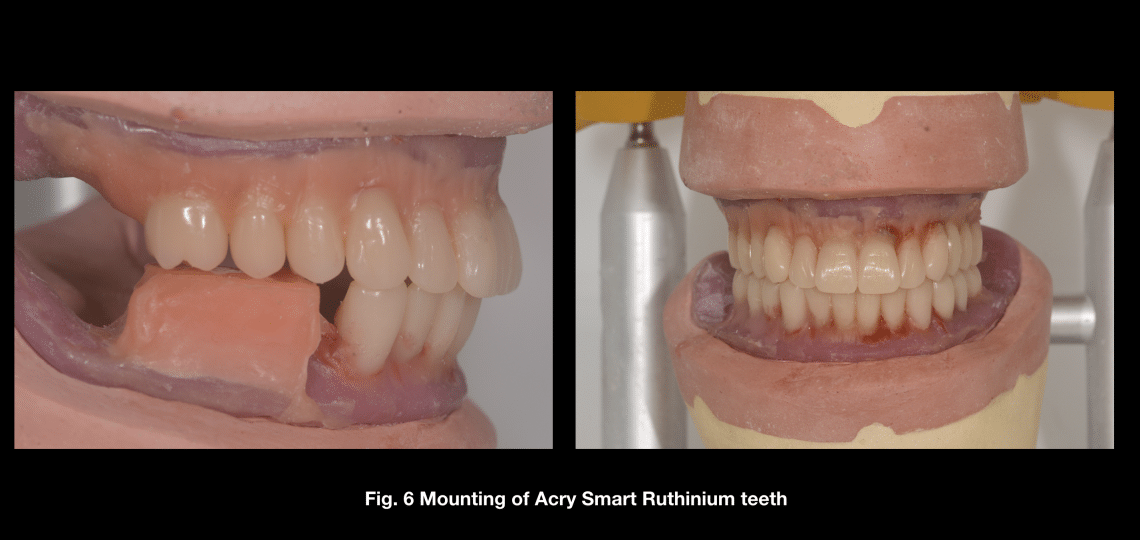 THE APPLICATION OF CAD - CAM TECHNIQUES FOR ALL-ON 4 - MyZerodonto