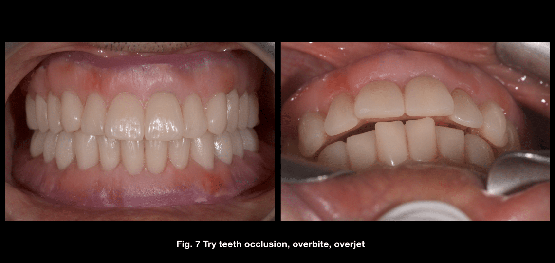 THE APPLICATION OF CAD - CAM TECHNIQUES FOR ALL-ON 4 - MyZerodonto
