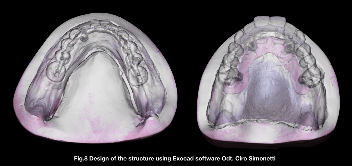 THE APPLICATION OF CAD - CAM TECHNIQUES FOR ALL-ON 4 - MyZerodonto
