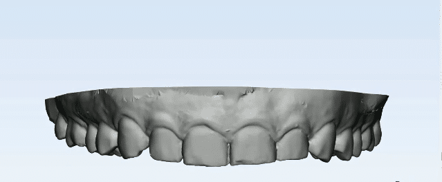 intra oral scan