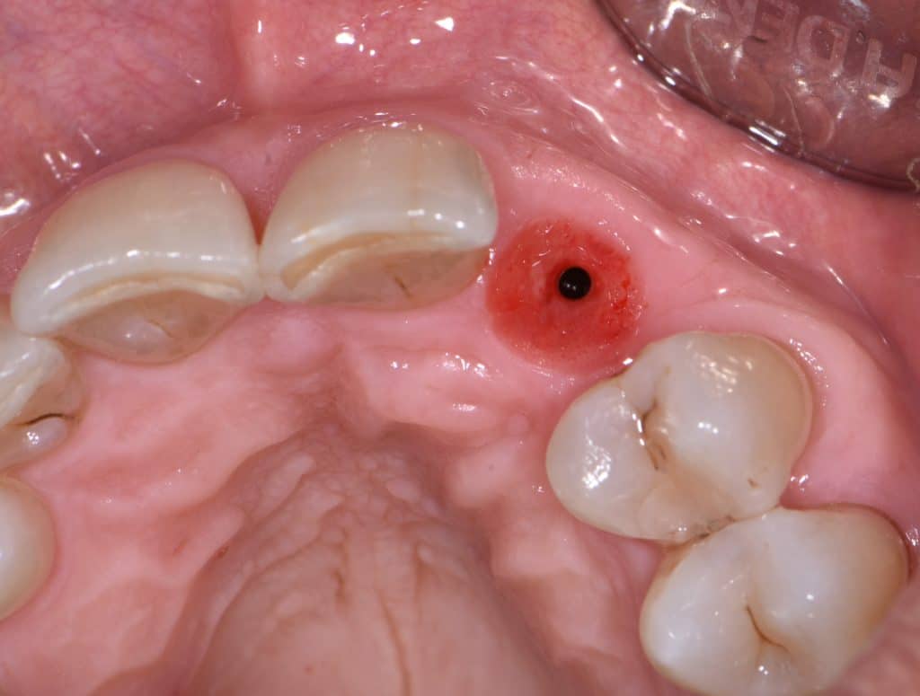 11 guarigione alla presa dell'impronta (3)