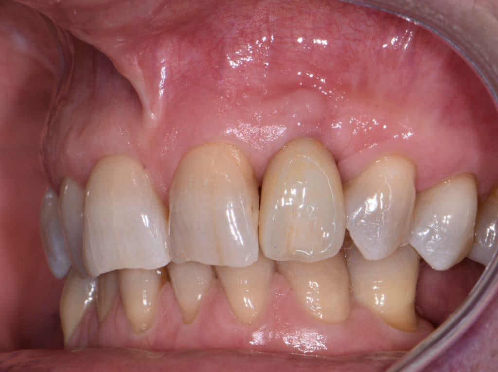 14 protesi definitiva (2) luglio