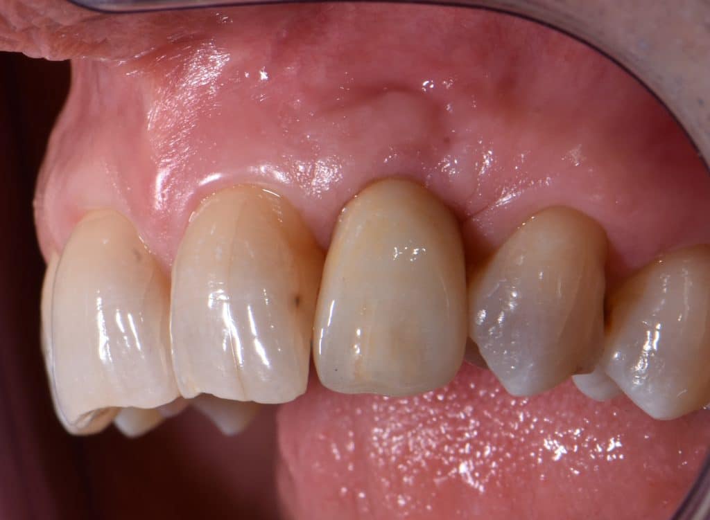 14 protesi definitiva (5)