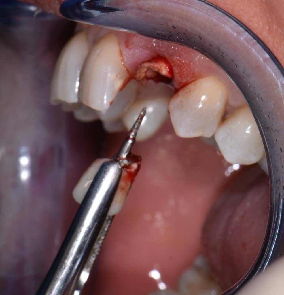 2 foto estrazione (3)