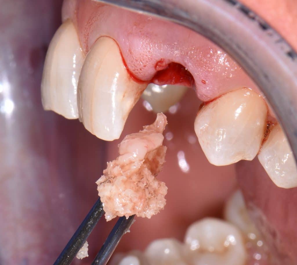 5,1 socket preservation (1)