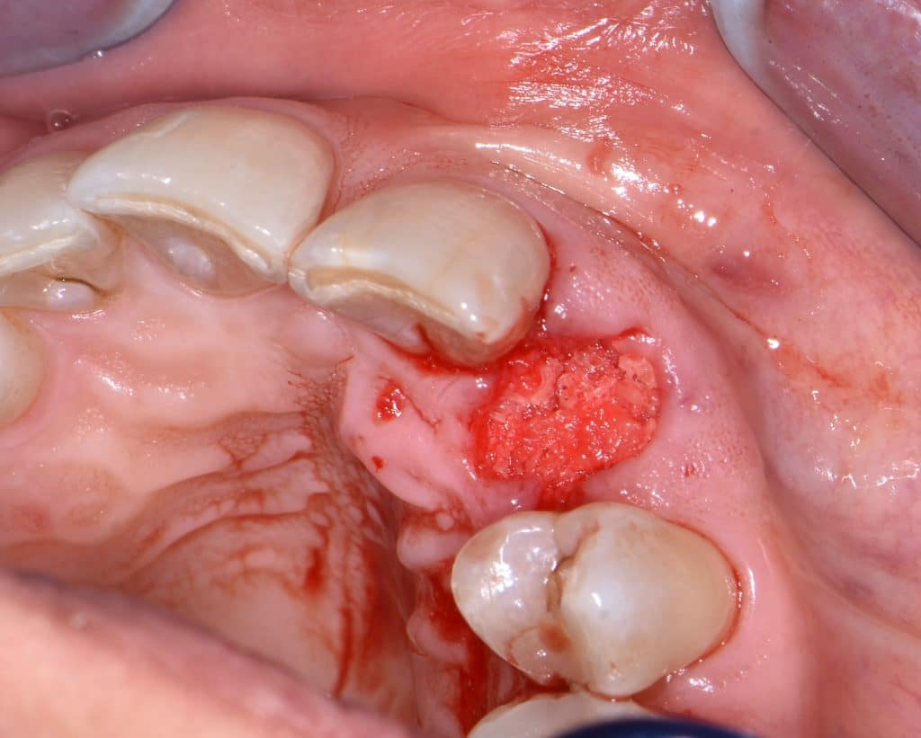 5,1 socket preservation (3)