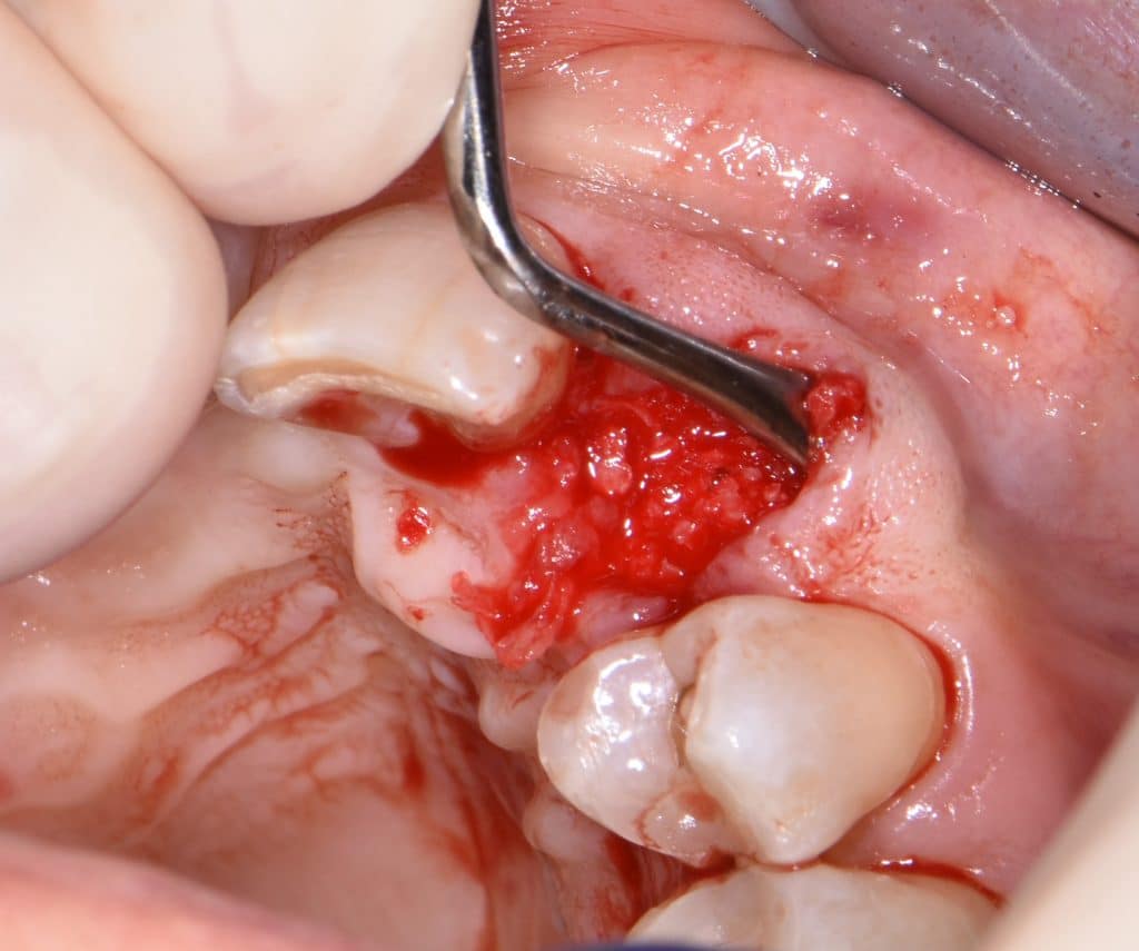 5,1 socket preservation (4)