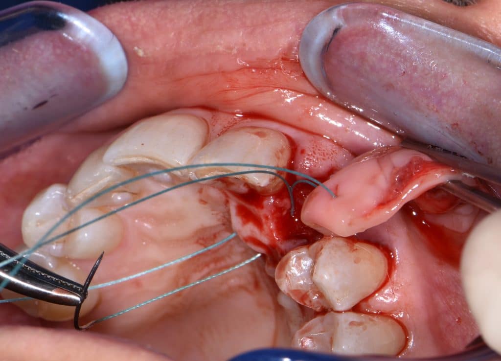 5,1 socket preservation (6)