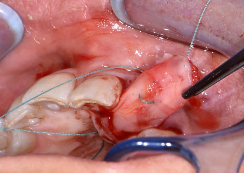 5,1 socket preservation (8)