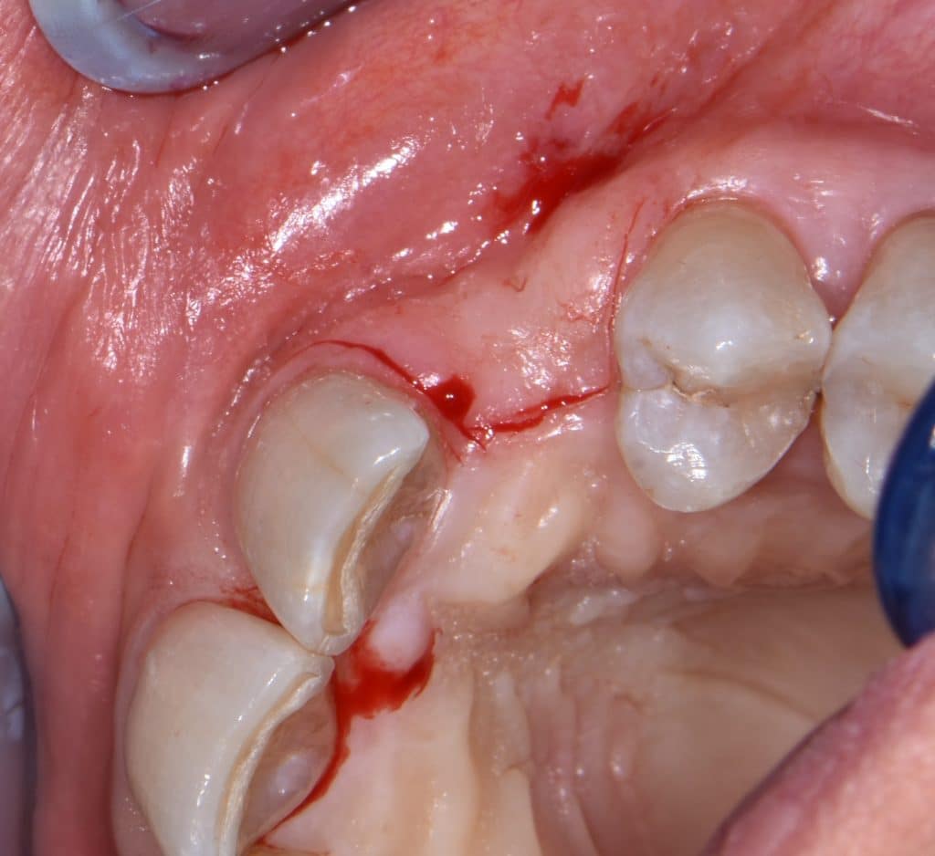 7 inserimento impianto 3,75x12 (1)