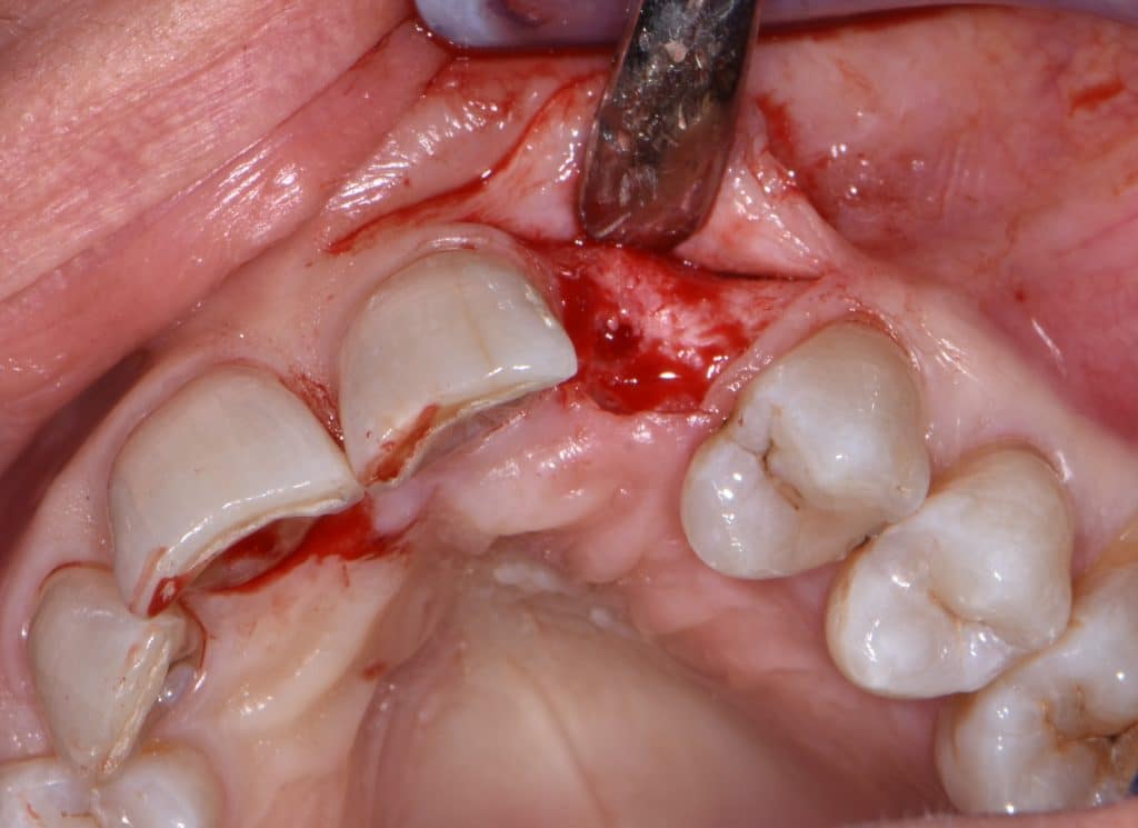 7 inserimento impianto 3,75x12 (3)