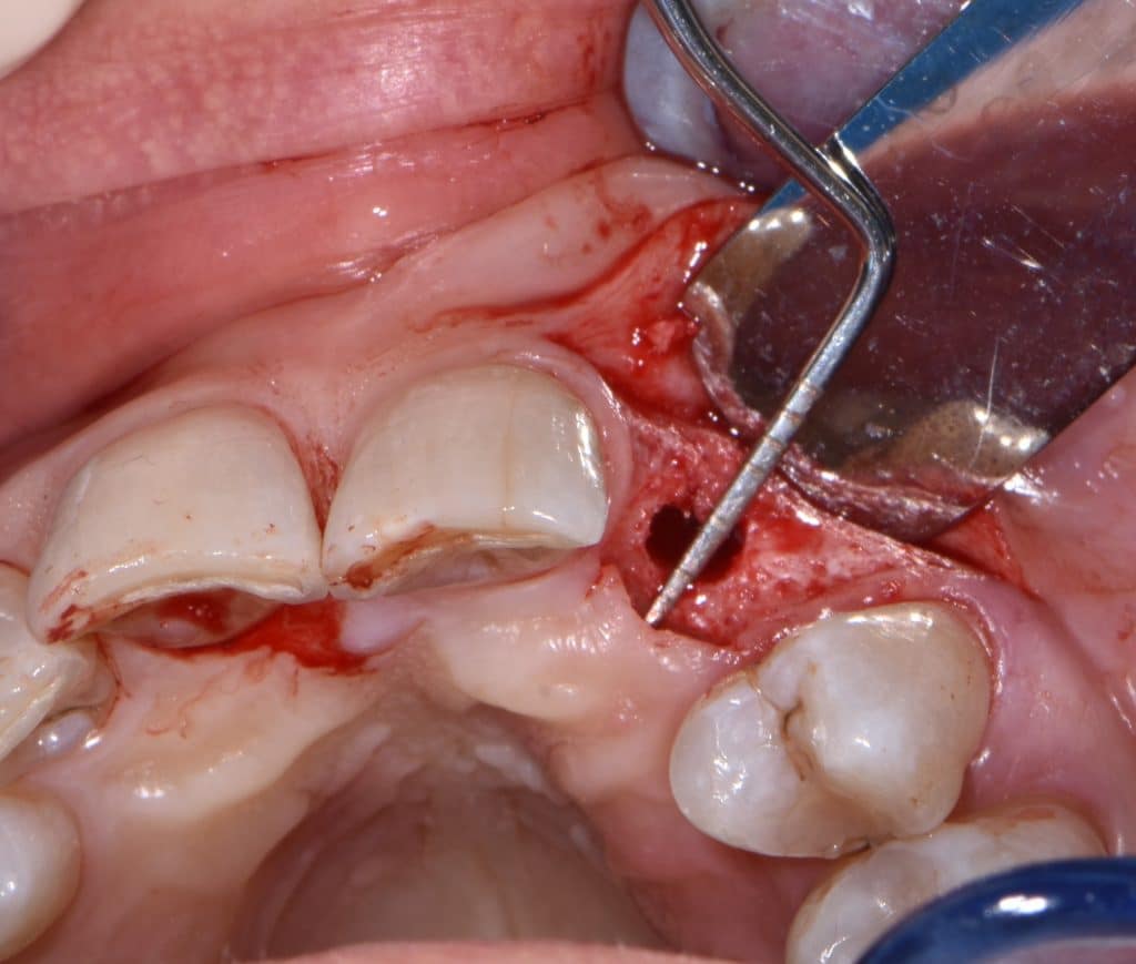 7 inserimento impianto 3,75x12 (4)