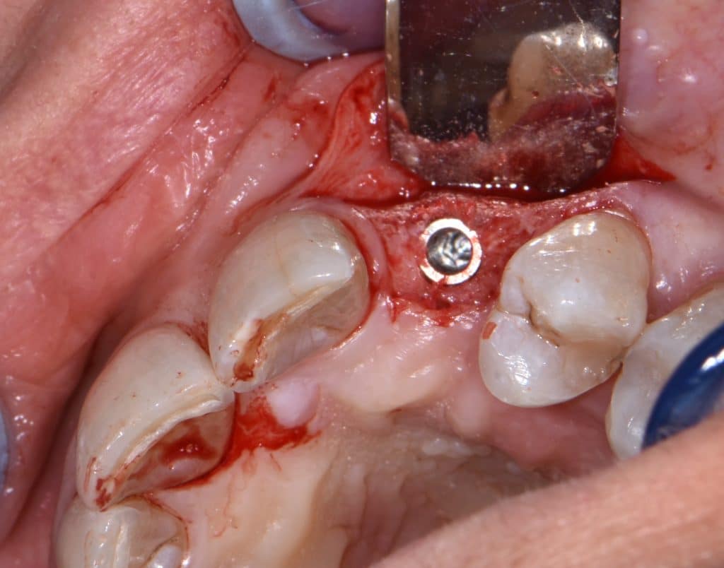 7 inserimento impianto 3,75x12 (7)