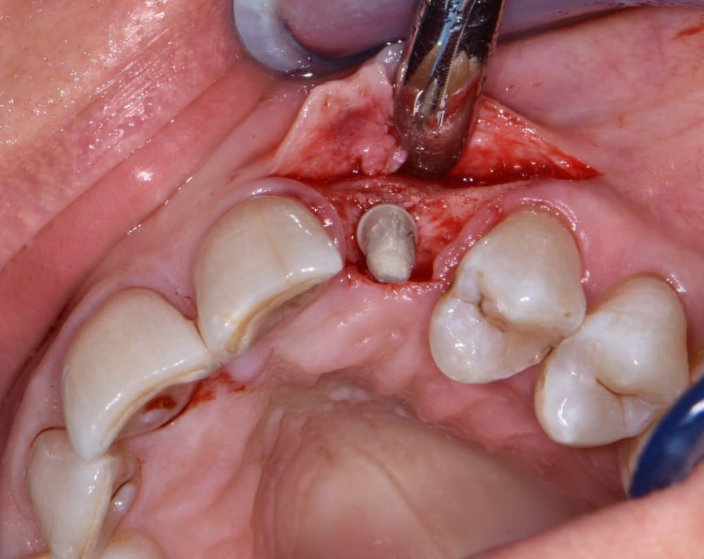 8 moncone e protesi provvisoria (1)