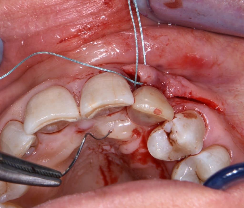 8 moncone e protesi provvisoria (2)