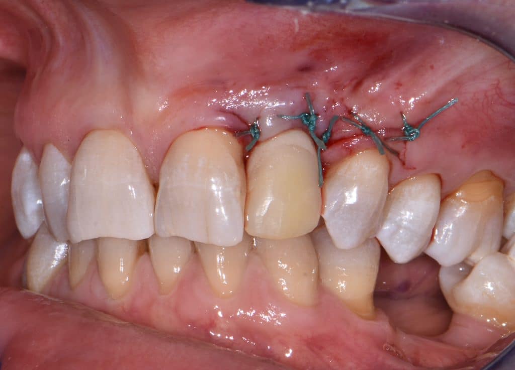8 moncone e protesi provvisoria (5)