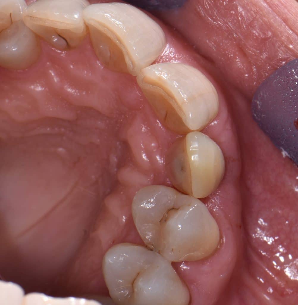 9 guarigione su prossisorio (4)