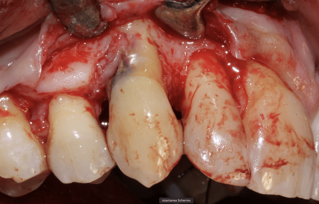 Vestibular aspect pre bone surgery