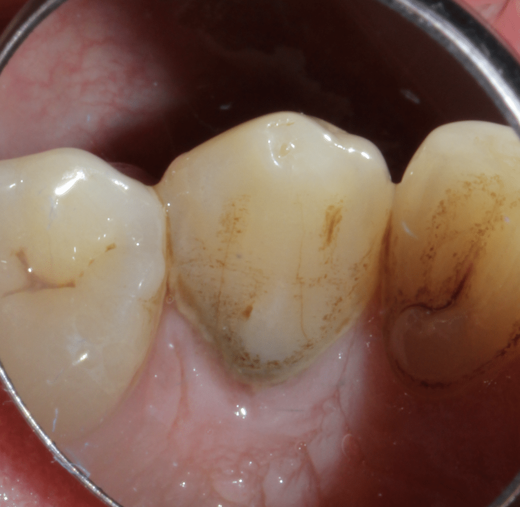 Preoperative buccal surface