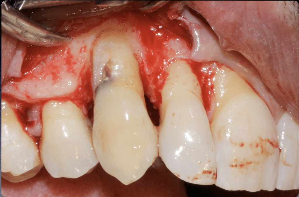 Vestibular aspect post bone surgery
