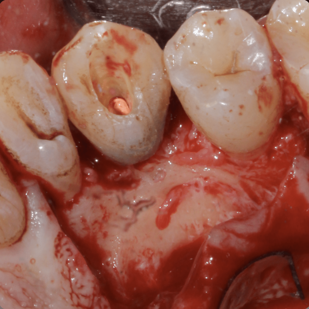 Buccal aspect pre bone surgery