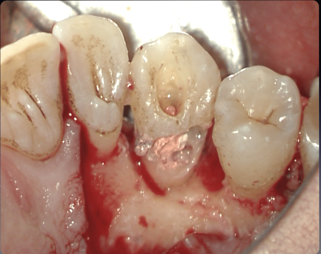 Buccal aspect after bone surgery