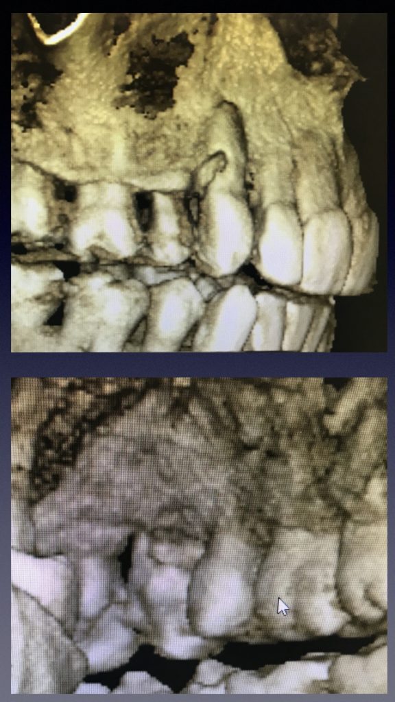 CBCT