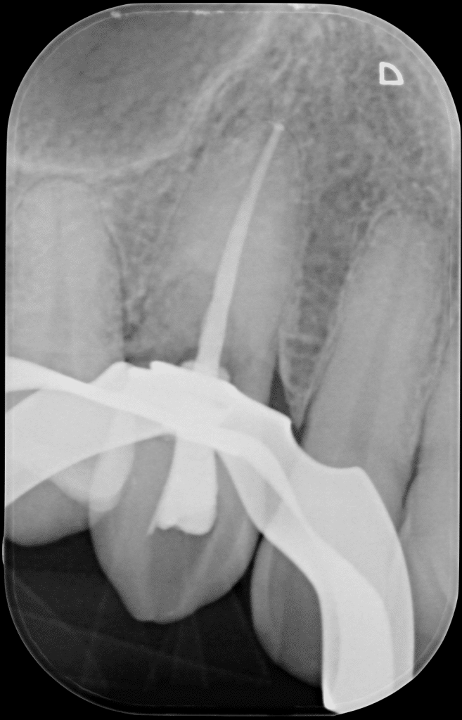 rx post endodontic treatment