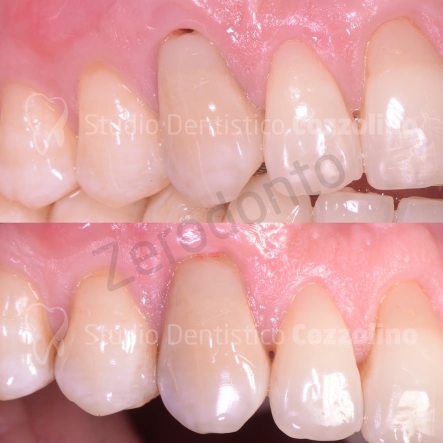 BEFORE AND AFTER BIODENTINE