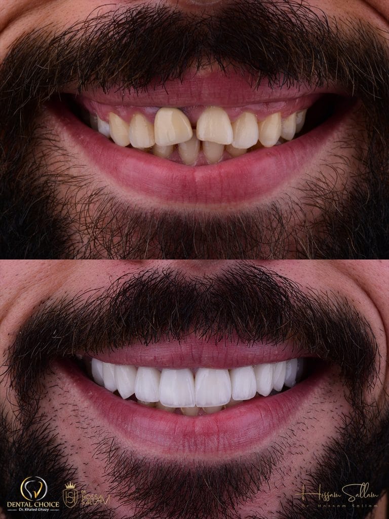 Fig.20 Before & after frontal
