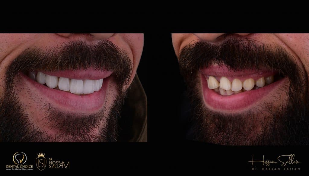 Fig.21 Before & after 45 degree