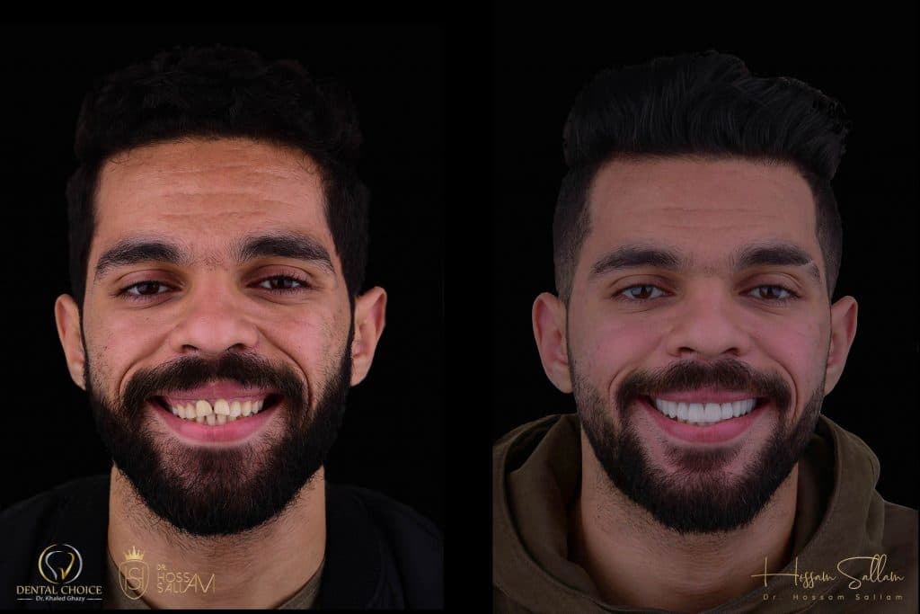 Fig.24 Two weeks recall