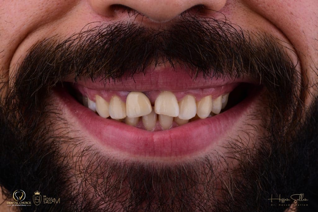 Fig.2  Smile Frontal