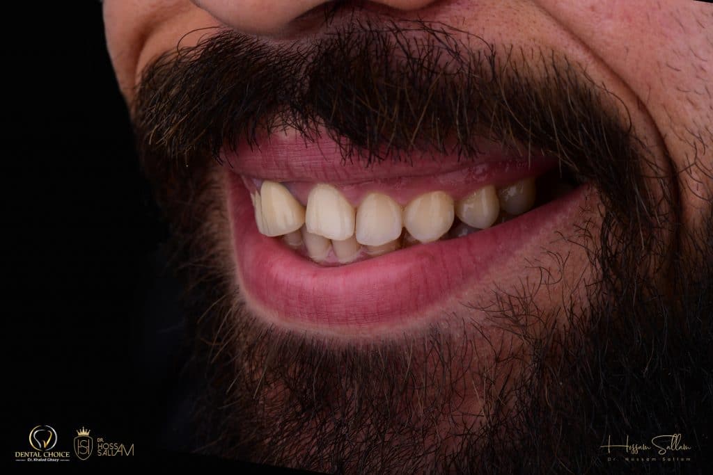 Fig.3 Smile 45 degree