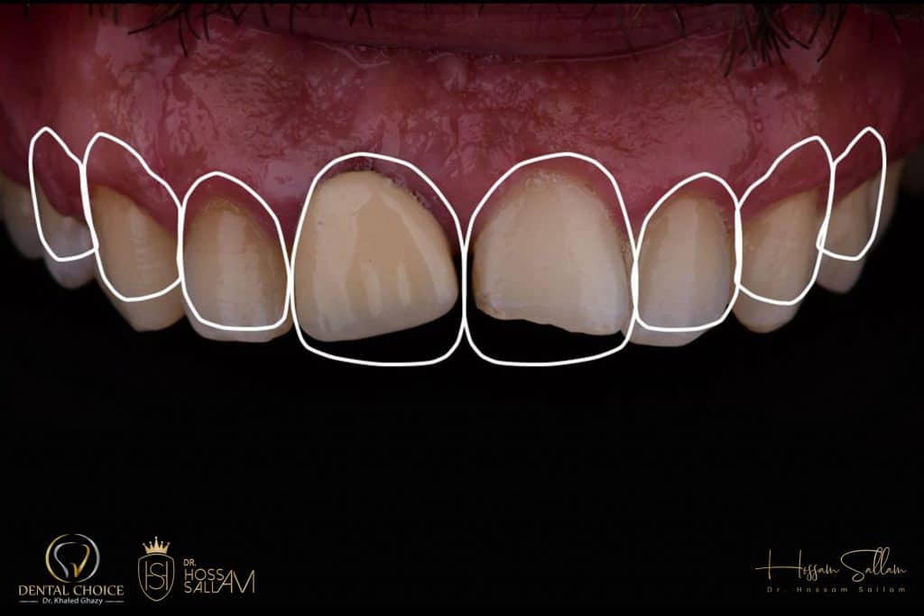 Fig.8 Digital Smile design 