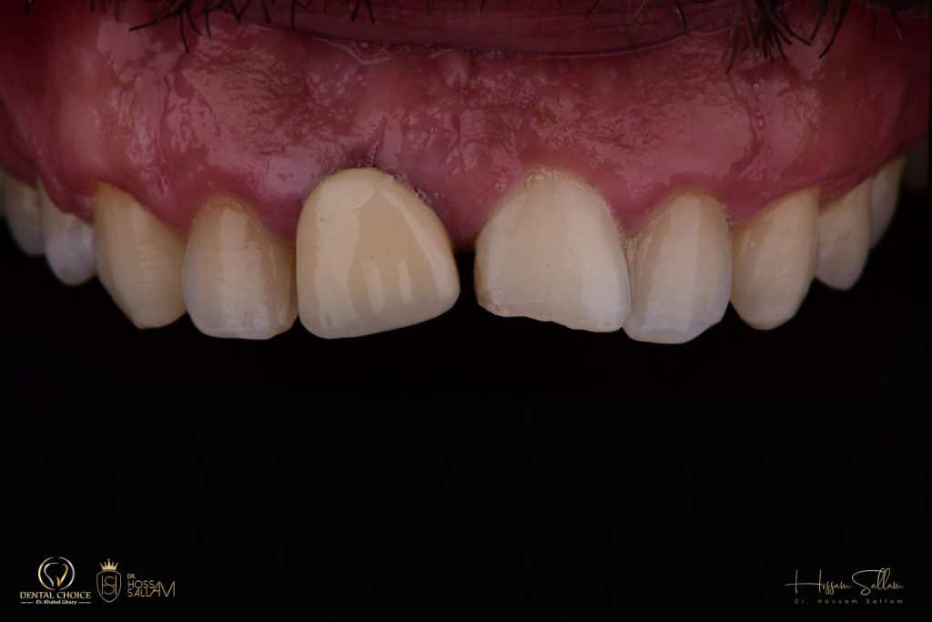 Fig.5 Contrasted Intra Oral