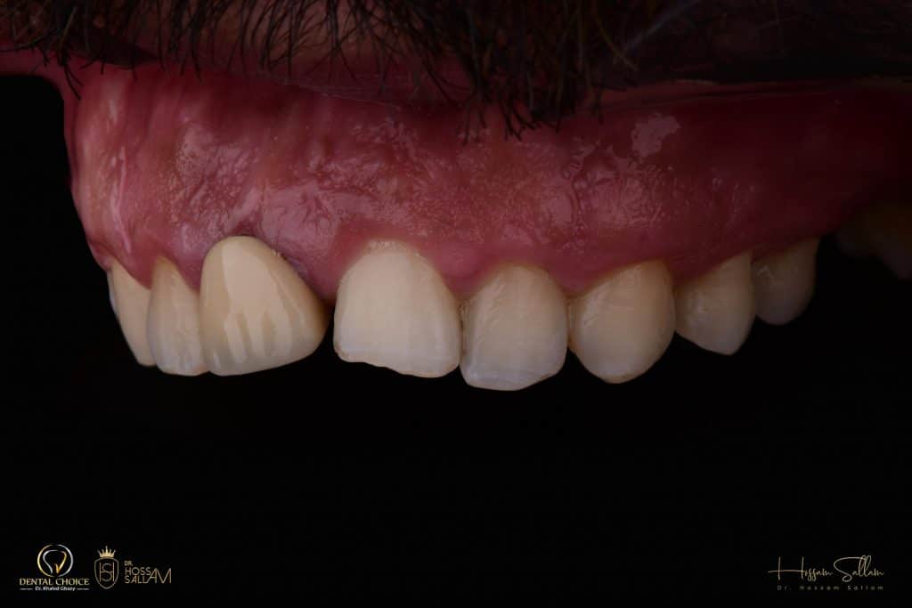 Fig.6 contrasted Intra Oral 45