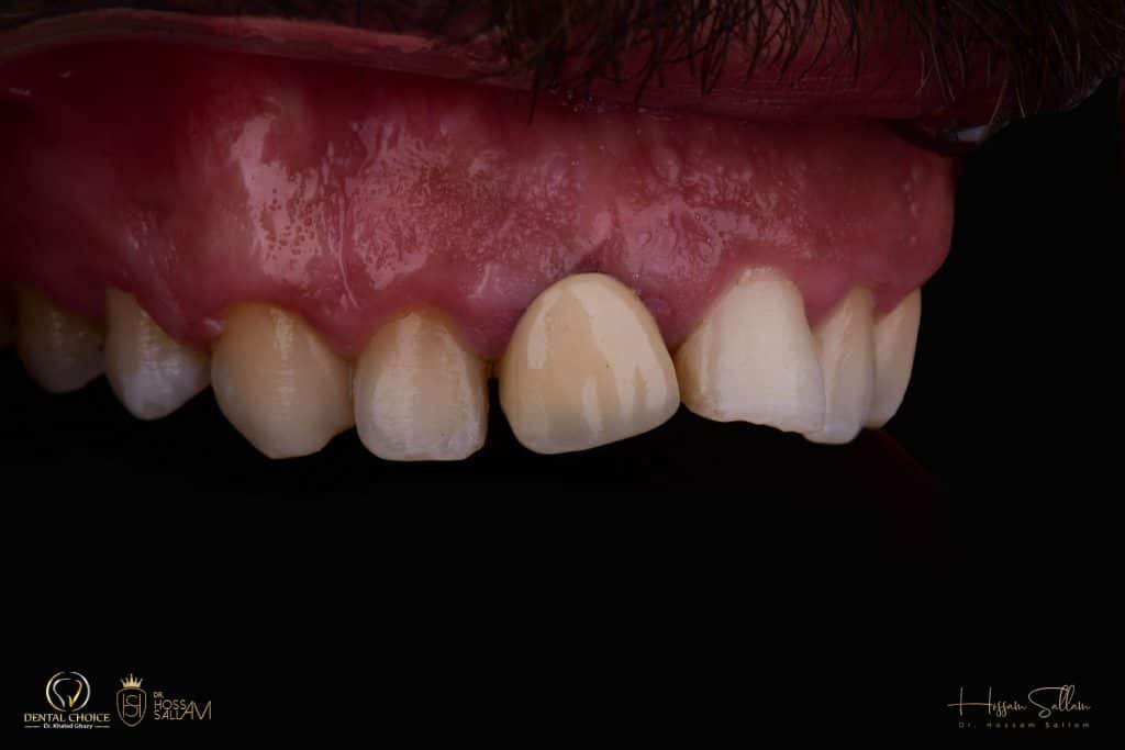 Fig.7 contrasted Intra oral 45