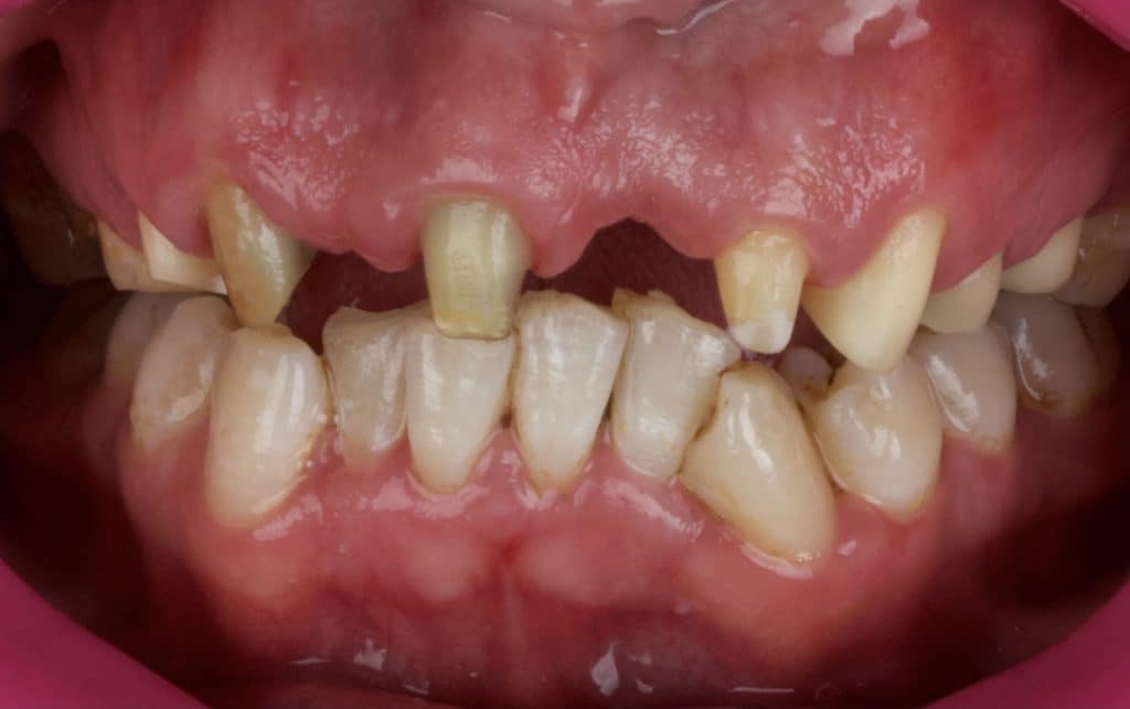 Post and core build up then reduction