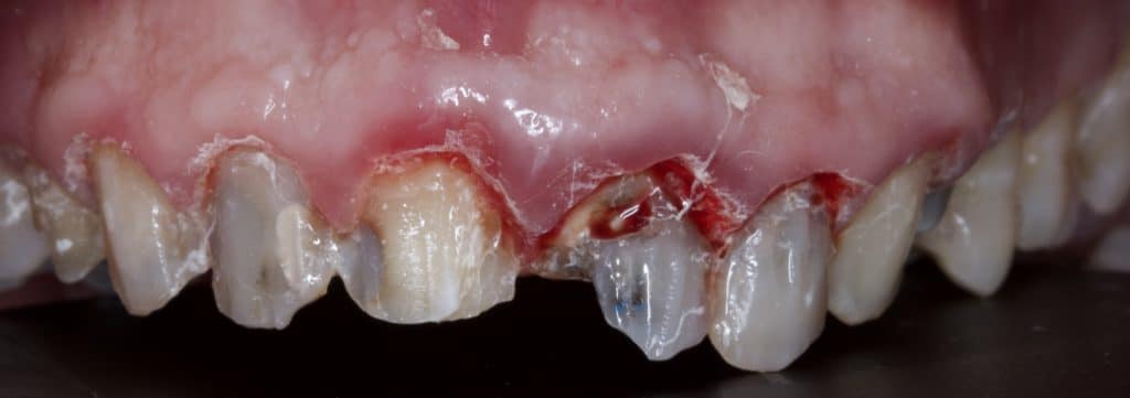 After removing the old restoration