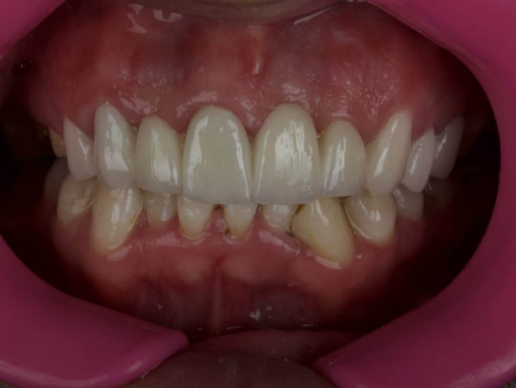 Immediately after cementation