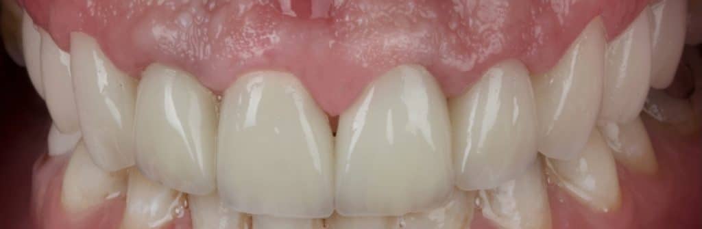 Immediately after cementation