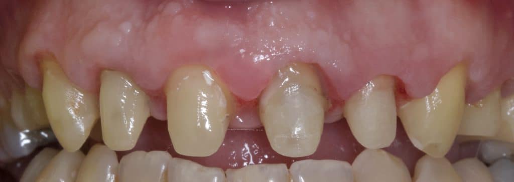 After post and core build up and preparation